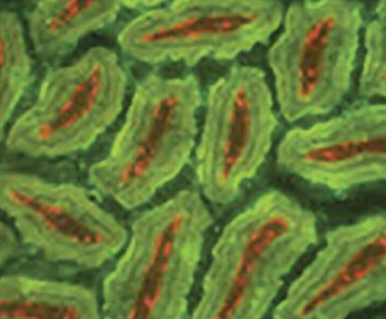 The Mysterious Tale of von Willebrand Disease