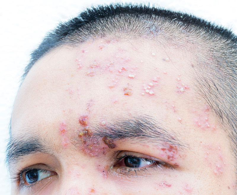 Photo of man's face with shingles on it