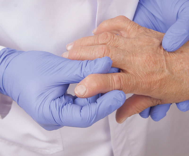 Photo of a healthcare worker examining a patient's hand