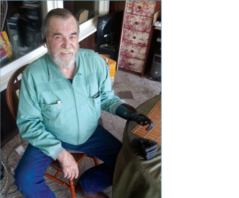 Photo of Dr. Robert Doty with prosthetic arm.