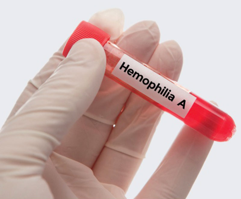 Photo of a gloved hand holding a vial that says "hemophilia A"