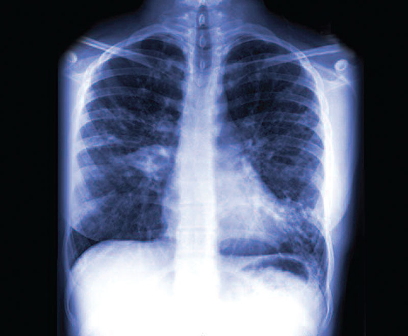 Inhaled Alpha-1 Proteinase Inhibitor Safe, Well-Tolerated and Effective in Raising Sputum Levels in Patients with Cystic Fibrosis