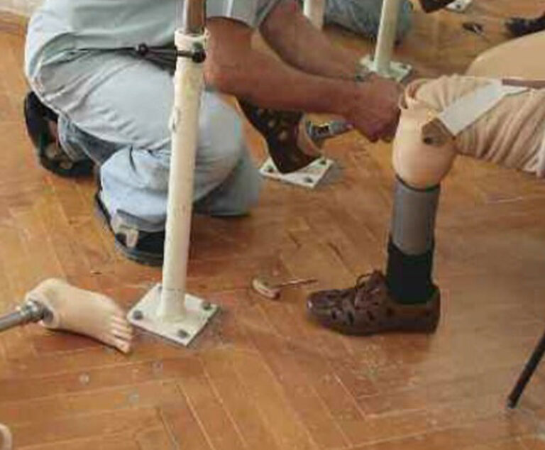 Image of a patient getting fitted for a prosthetic leg