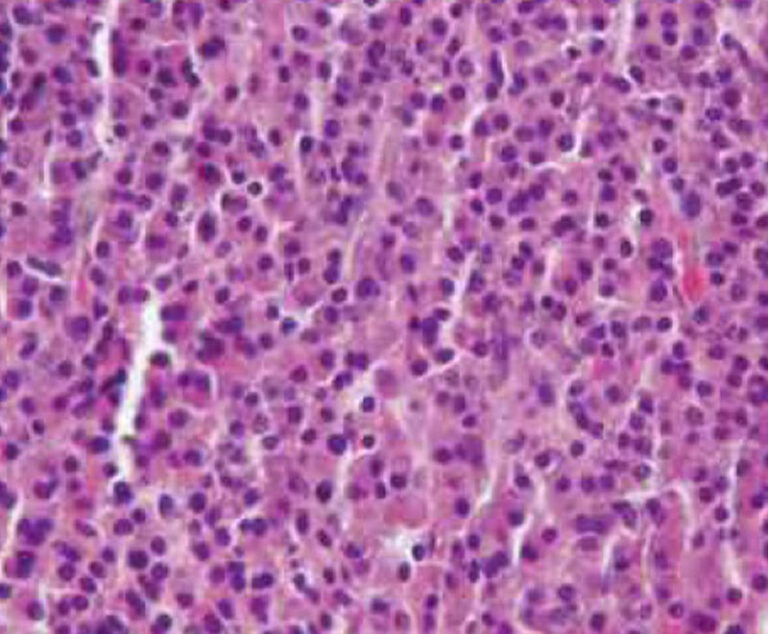 Empliciti Approved by FDA to Treat Multiple Myeloma