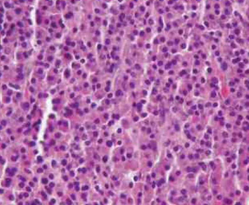Empliciti Approved by FDA to Treat Multiple Myeloma