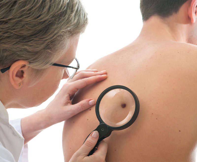 Doctor looking at patient mole