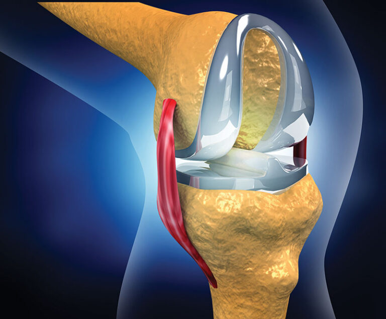 Concept art of joint replacement.