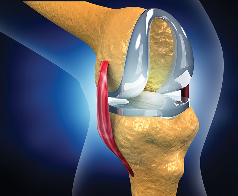 Concept art of joint replacement.