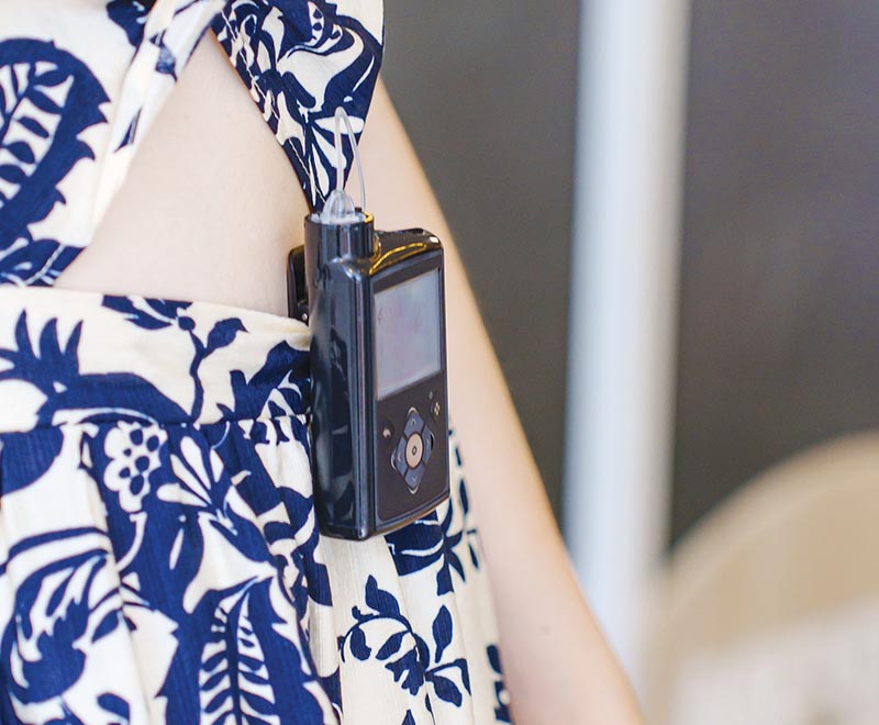 Glucose pump worn on a person's waist band.